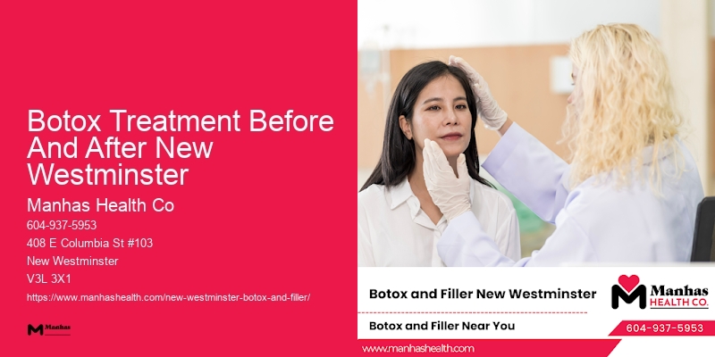 Botox for cheekbone definition Botox Treatment Before And After New Westminster