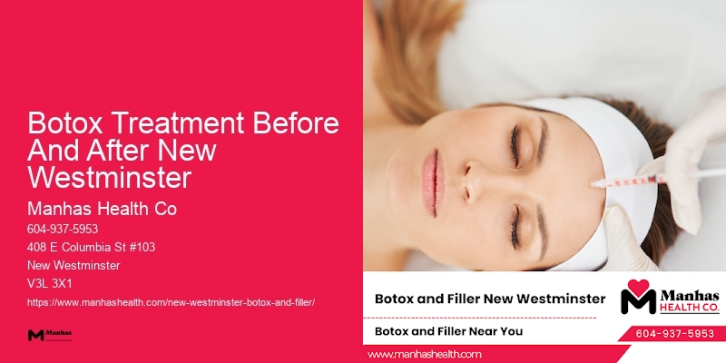 Botox for facial contouring Botox Treatment Before And After New Westminster