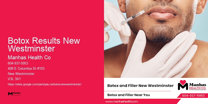 Botox Results New Westminster Botox before and after